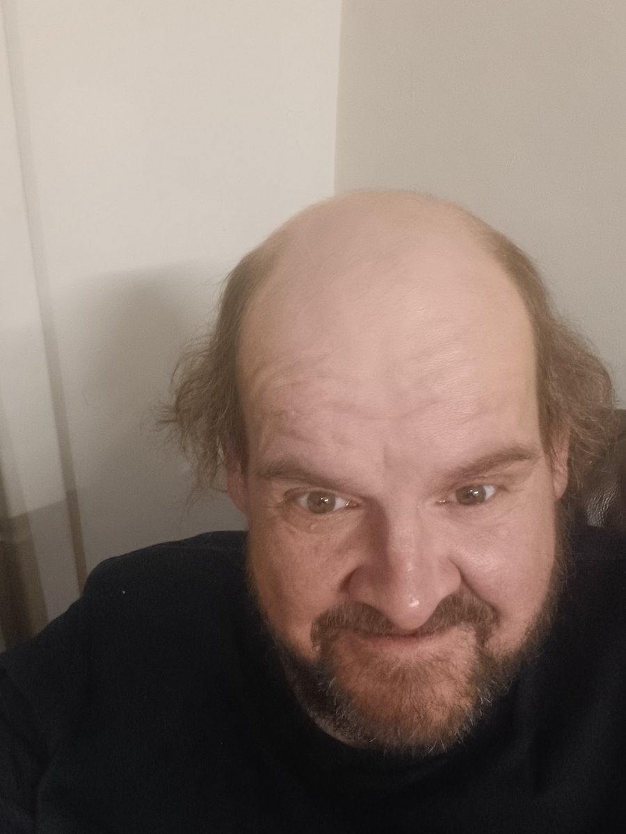 Raps_77's tweet image. Just wandering whether to get a hair transplant 🤔🤔🤔🤔🤔