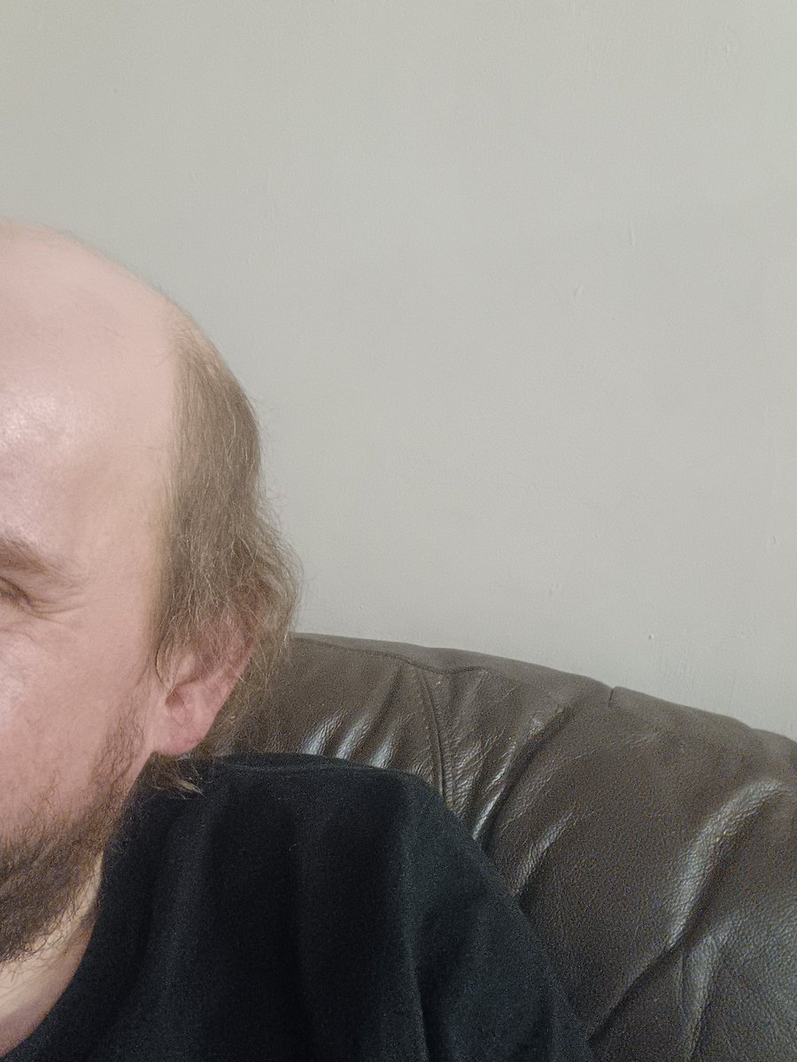 Raps_77's tweet image. Just wandering whether to get a hair transplant 🤔🤔🤔🤔🤔