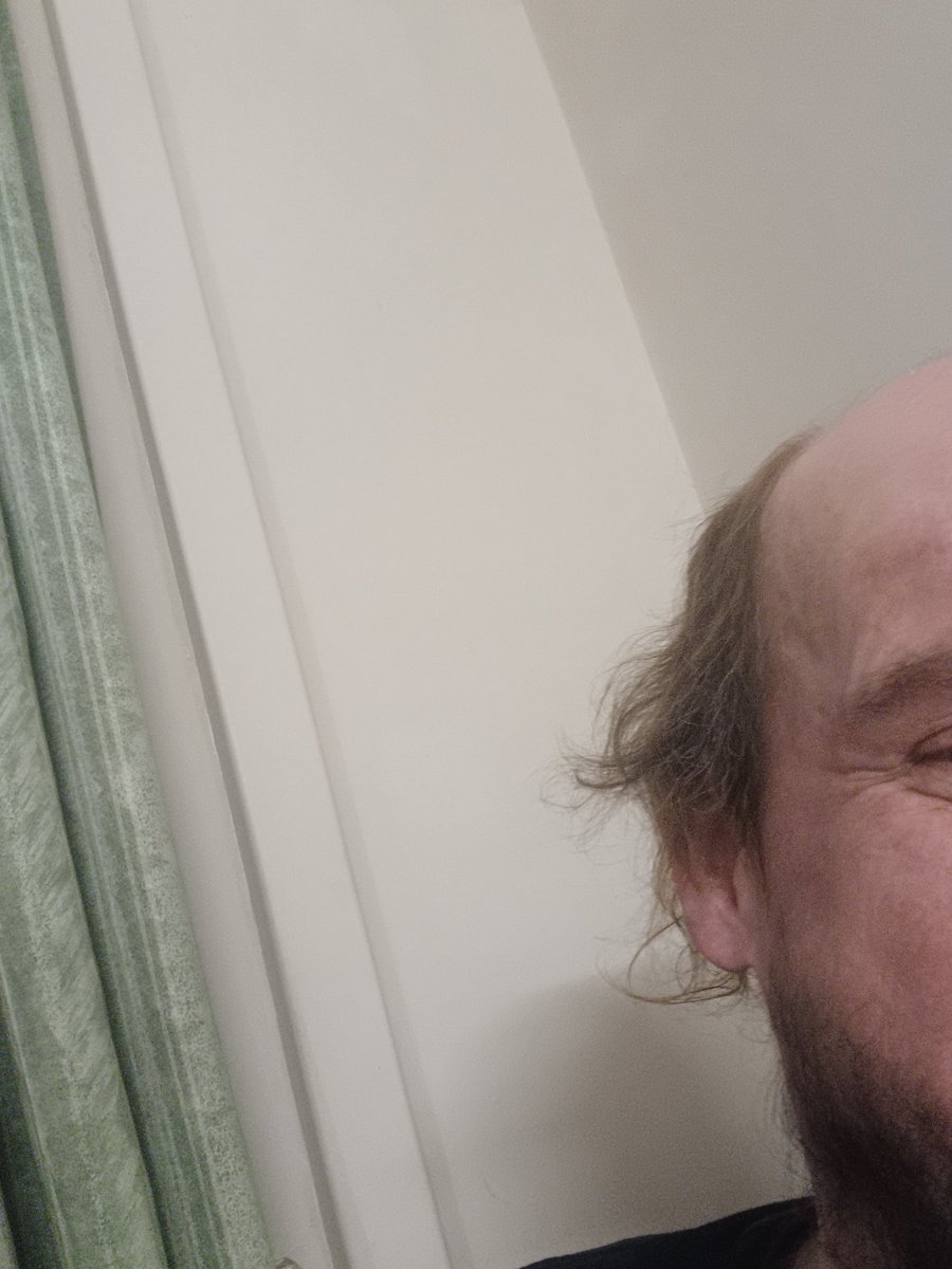 Raps_77's tweet image. Just wandering whether to get a hair transplant 🤔🤔🤔🤔🤔