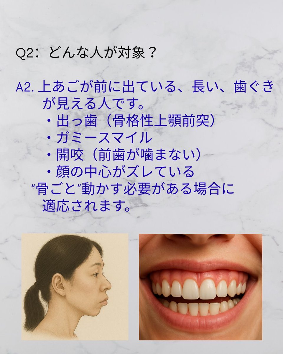 6zKVomo3Yf92819's tweet photo. 骨切り手術のルフォーって？ 結論:ルフォー＝上あごを動かして顔の中心を整える手術。噛み合わせ・笑顔・横顔をトータルで改善します。
【骨切り（顎矯正手術）無���カウンセリング実施中】#骨切り #ルフォー #小顔になりたい #ガミースマイル #顔面非対称 #出っ歯 https://t.co/NtoZmtDSOK
