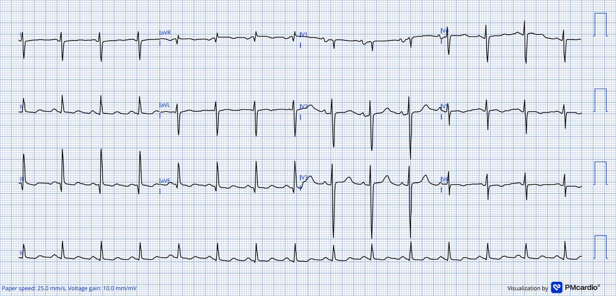 A 42 y/o woman presents to outpatient clinic with:
• Bilateral lower extremity edema
• Ascites
• Dyspnea on minimal exertion

ECG shows:

What are the electrocardiographic diagnoses? #pmcardio #ecg