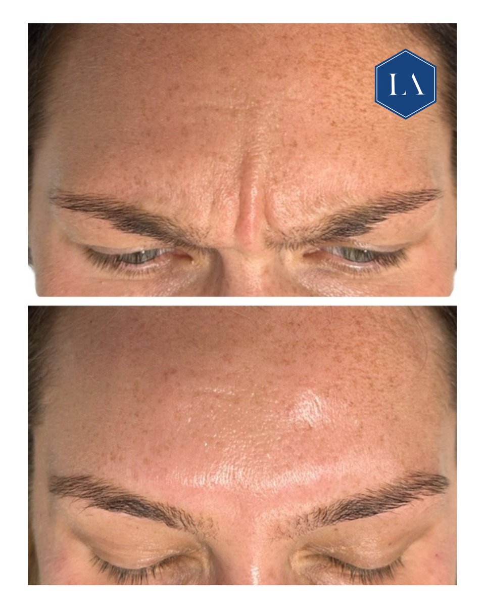 #nofilterneeded ✨ Impressive results, visible transformation. 
Frown line treatment. Subtle, natural results, preserving expressions. Top-ups ensure a perfectly tailored, long-lasting look.

#glabellarlines #frownlines #luxtonaesthetics #essexclinics #kentclinics