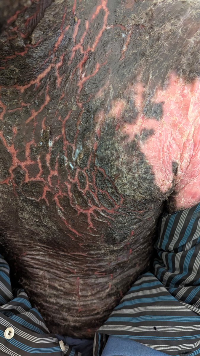 To the Global Medical Community,
With the patient’s informed consent, I share this case in the spirit of collaboration, compassion, and collective responsibility.
Today, I received a 34-year-old male, a known epileptic for several years, who presented with severe itching, pain,