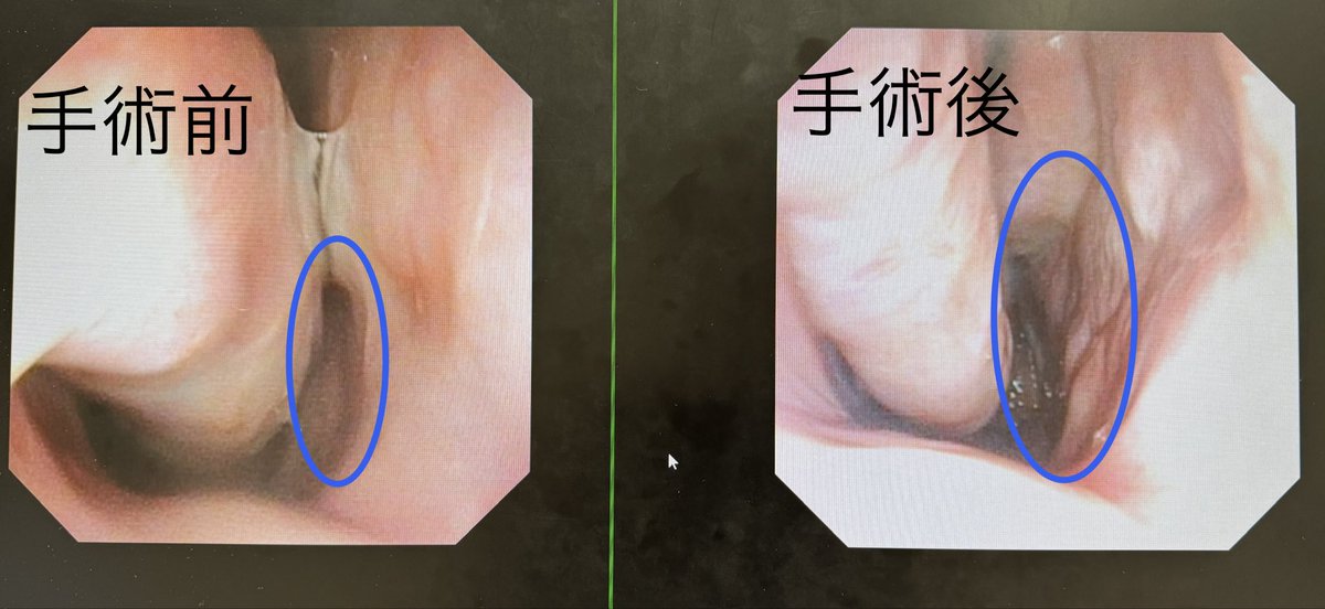 鼻詰まりは手術で半永久的に改善できます。
花粉症でお悩みの方にも勿論効果があります。
時期を選ばない手術です。いつでも受けて頂けます。