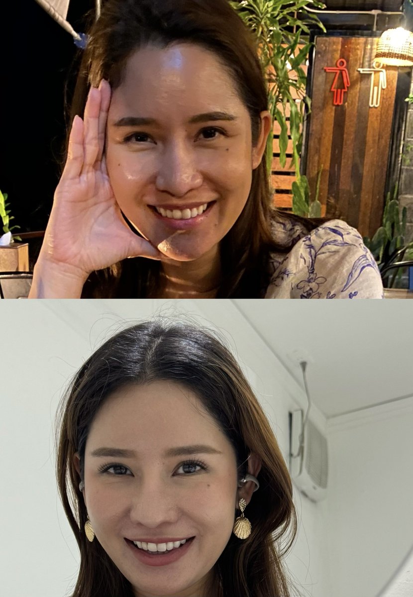 2563 vs 2569 
จัดฟันกันเถิดชาวเรา แก่แล้วฟันมันล้มง่ะ นี่ไม่เคยจัดฟันนะ แต่ฟันหน้ามันบิดมากขึ้น เลยไปจัดฟันใส หมอบอก 6 เดือนเสร็จ ปาไป 2 ปี กาจะบู้