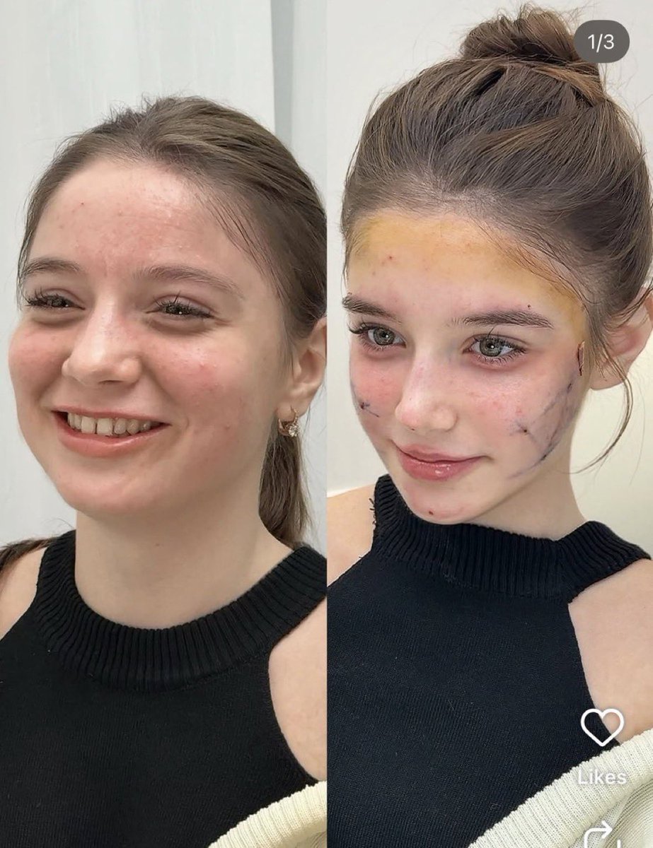 Moon1ightSt's tweet image. This is AI-generated 🤖

The black top appears similar in fabric and color, but the neckline cut is different 👚

She should have a lot of bruising and swelling on her face after such a major surgery, rather than just some pre-surgery marking ink on her face afterward