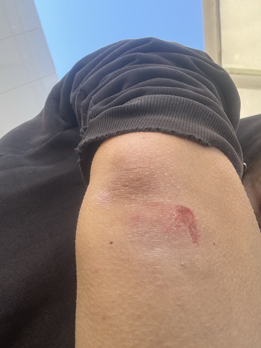 TORATORA121107's tweet photo. 今朝ド派手に転んだのに傷が弱々しい😭😭
痛みだけ残って最悪や🤣🤣
足上がらずコケるとかもう歳やな👴 https://t.co/RCqDw0F9UC