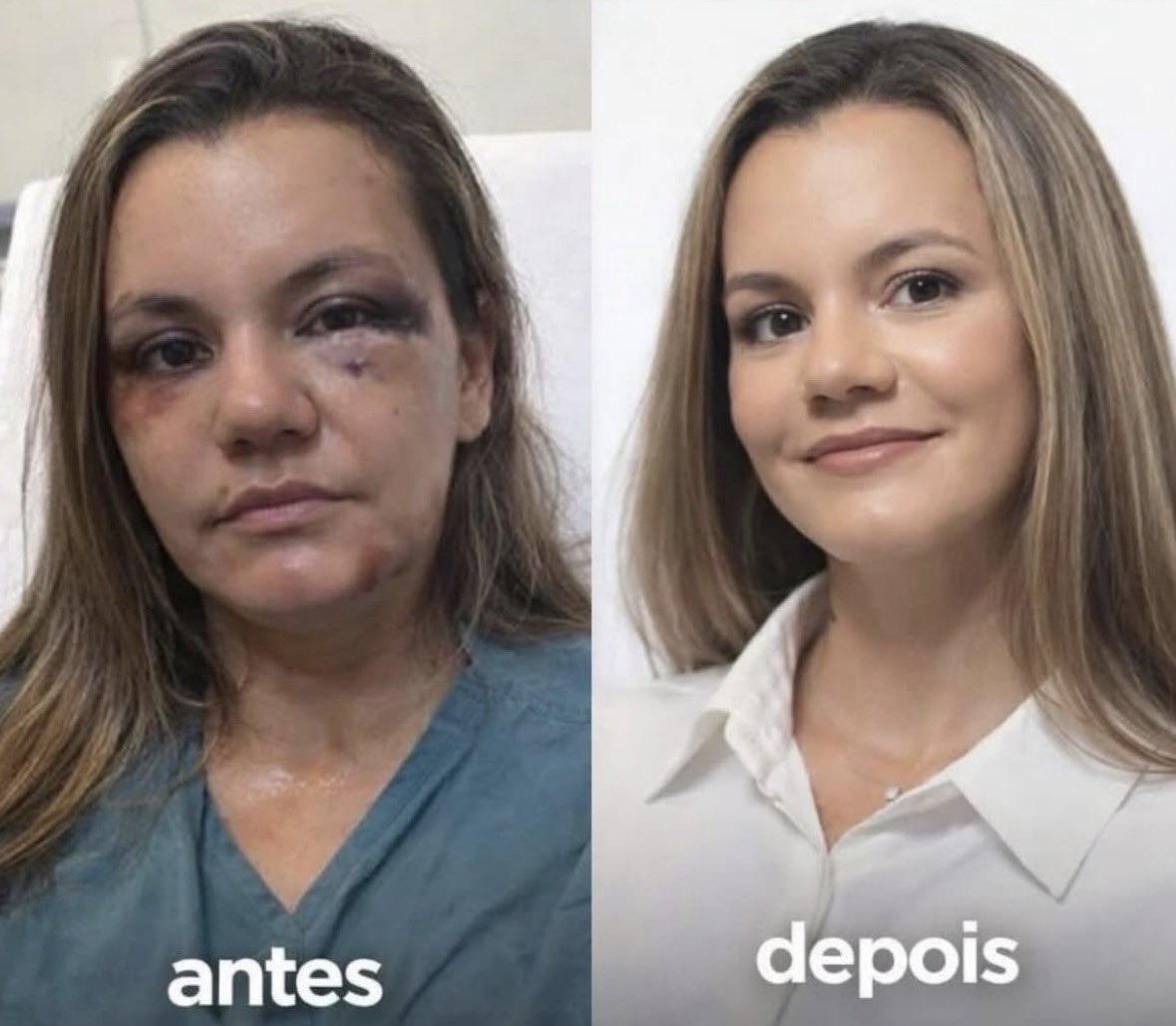 🚨VEJA: Mulher que foi agredida com mais de 60 socos em um elevador reconstruiu seu rosto 100%