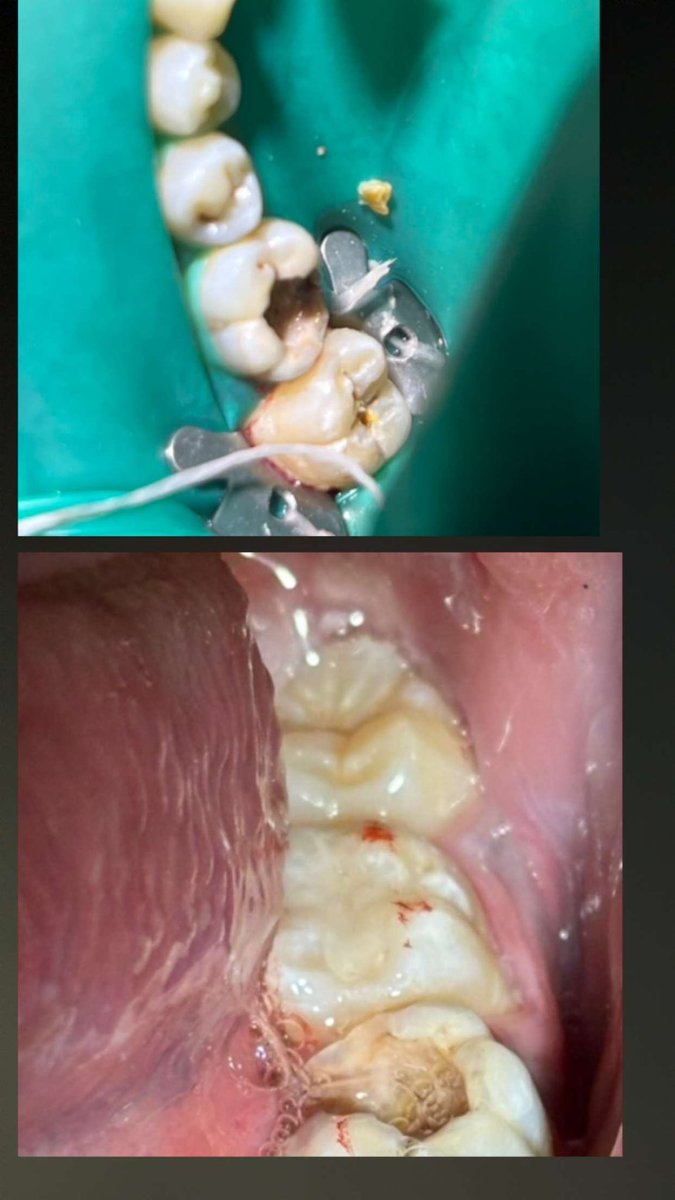 Extensive Class I caries management on
#37
Restored with resin composite restoration . 
Satisfied patient 🦷