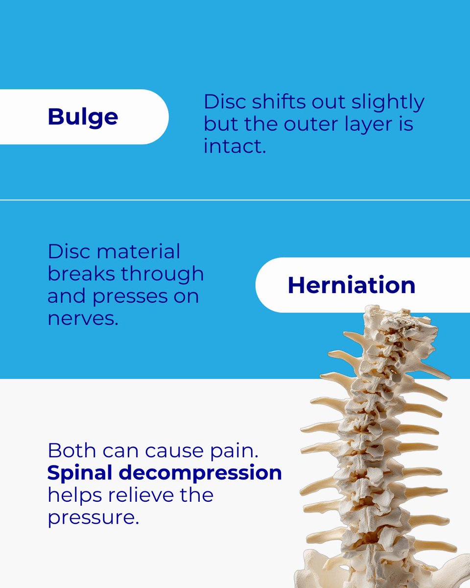 JDchiro's tweet image. Bulge or herniation — pressure is the real problem.
Spinal decompression helps relieve it naturally.
👉 Book your consultation today.
#BackPainRelief #SpinalDecompression #SciaticaHelp #NonSurgicalHealing