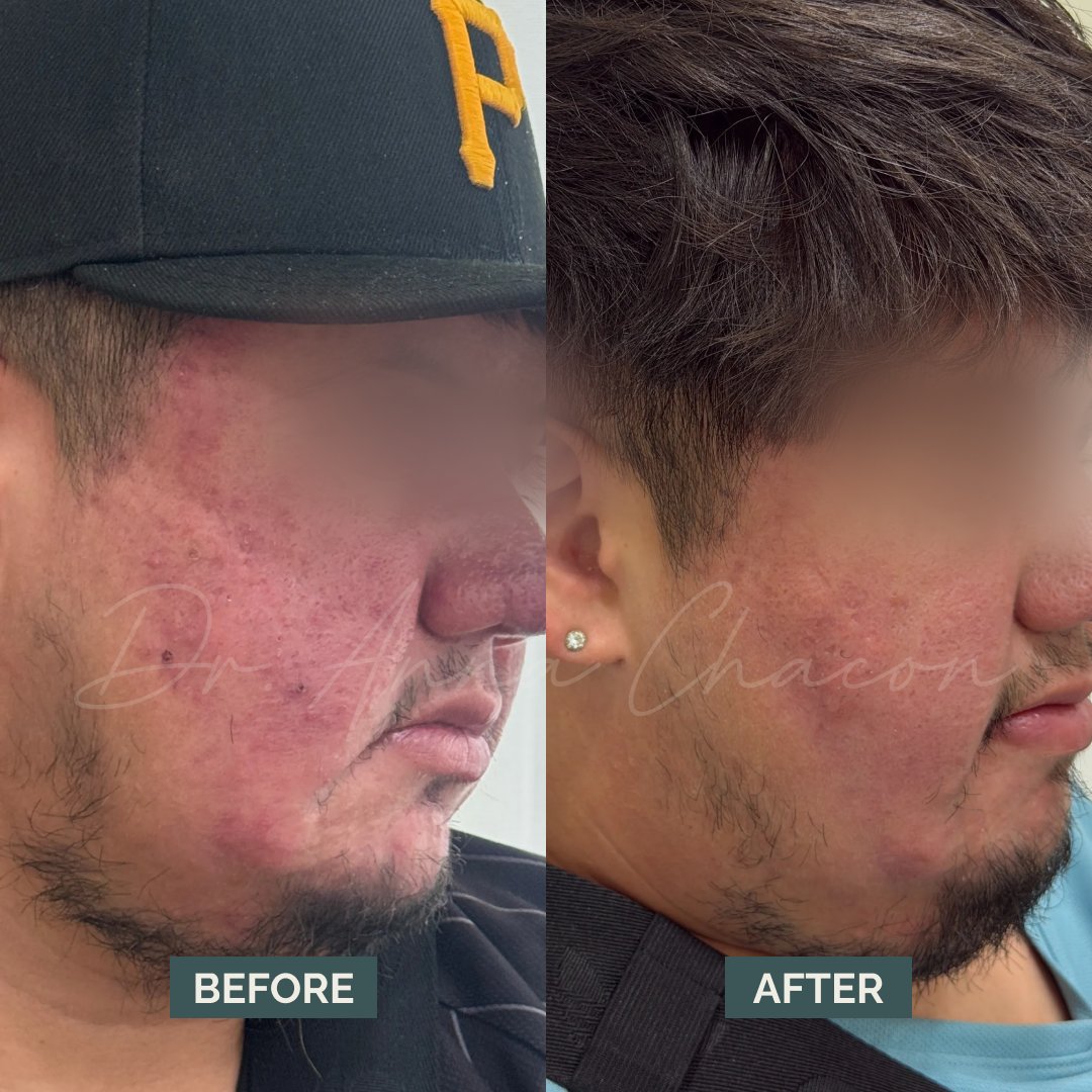 DrMiamiDerm's tweet image. Acne is more than “a breakout.”

If you’re tired of breakouts that won’t quit or treatments that don’t work → that’s a signal your skin needs expert guidance.

📲 Book with me!
drannachacon.com

#acnetreatment #dermatology #acne #acnescar #miamiderm
