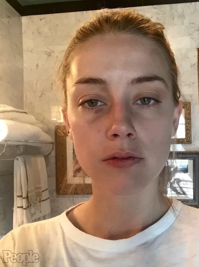 TeresaCSilvaR's tweet photo. Heard's "overwhelming evidence" that she was brutally assaulted and Depp was extremely violent...
Make it make sense
This is not rocket science
Depp deserves a public apology.
#FalseAllegations
#PathologicalLying https://t.co/eYiSkbxZl9