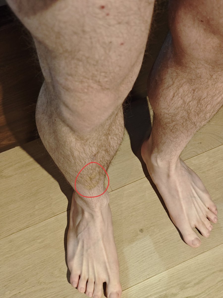 J'ai un énorme bleu sur le tibia :(