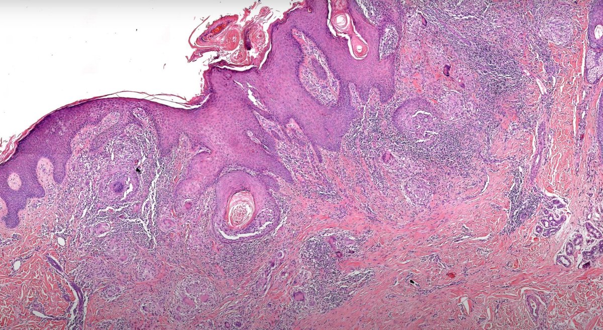 JMGardnerMD's tweet photo. Skin infection in adult from southwestern USA. Diagnosis? 
Answer ✅  https://t.co/HgQNNsb09Z  
#pathology #pathologists #pathTwitter #dermpath #dermatology #dermatologia #dermtwitter #infectiousdisease #IDpath https://t.co/BjdLNcjSnm