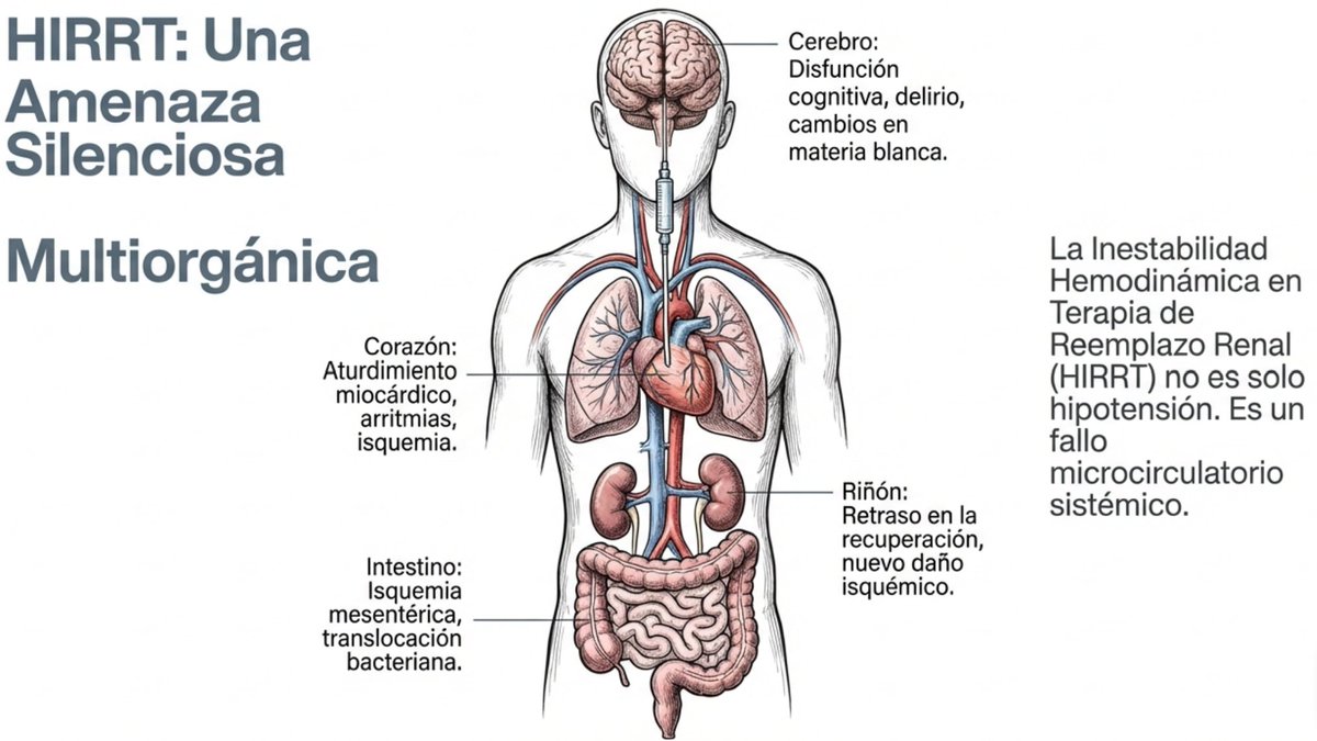 EDL1976's tweet photo. ¿Estamos indicando mal la ultrafiltración en pacientes críticos?. La sobrecarga de fluidos es prevalente, pero su extracción excesiva puede causar hipoperfusión tisular e inestabilidad. Urge un cambio hacia un cuidado individualizado.
+4

DOI: 10.1186/s13054-026-05836-x 🔬 https://t.co/Qax7SvAVcT