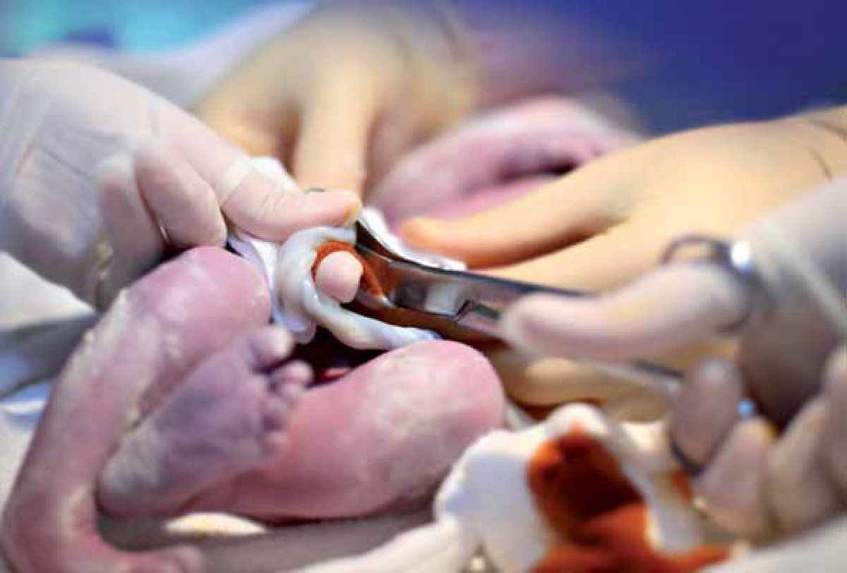 NICU_Musings's tweet photo. Interesting finding that provision of 100% oxygen to newborns undergoing deferred cord clamping does not increase fetal pO2 in the umbilical cord vs provision of 30% FiO2.

https://t.co/sSP3uim0No

#neonatal #nicu https://t.co/BaYZvkFVKY
