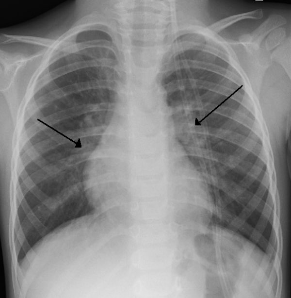 Dr_Shiv_kumar_'s tweet photo. Pulmonology deep dive- 🫁 2️⃣

🚨 32-year-old. Viral fever last week.
Now persistent cough + streaks of blood in sputum what is this? 

Vitals stable. SpO₂ 98%

Diagnosis?

1️⃣ 🟢 Acute viral bronchitis with trivial hemoptysis.

Mechanism?
🔸 Inflamed bronchial mucosa
🔸 Capillary fragility
🔸 Forceful cough → Small superficial bleed.
Not every blood streak = bacteria.

Acute bronchitis is viral in >90% cases.

CXR- X ray will show no evidence of lung infiltrates or consolidation. Occasionally, chest x-ray shows increased interstitial markings consistent with thickening of bronchial walls.

2️⃣  Cough lasts 2–4 weeks.
That is NORMAL.

Guidelines (NICE/CDC):
❌ No routine antibiotics
❌ Sputum color ≠ infection severity
❌ Trivial hemoptysis alone ≠ pneumonia

Inflammation ≠ indication for antibiotics.

3️⃣Management:
🟢 Reassurance
🟢 Hydration
🟢 NSAIDs 
🟢 Antitussive if needed
🟢 Bronchodilators 

Repeated unnecessary antibiotics →
🔴 Antimicrobial resistance
🔴 Adverse effects
🔴 Microbiome damage

Treat the patient.
Not the anxiety.

#MedTwitter #MedX #Pulmonology