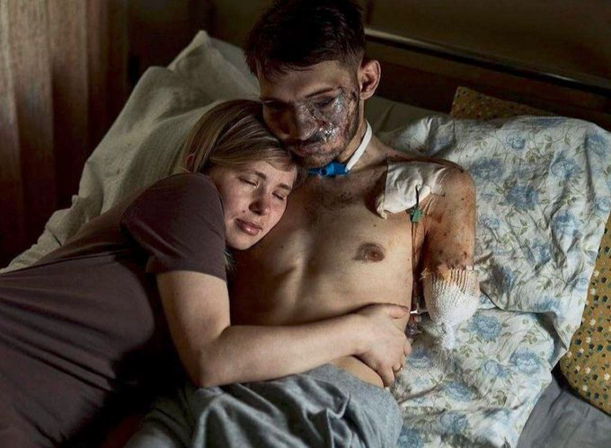 Und wenn ihr Trolle 🤡 meint, die Ukraine 🇺🇦 soll keine Unterstützung mehr bekommen 
Dieser Soldat würde ohne diesen widerlichen Krieg von RuZzland, noch gesund sein 
Er ist taub und blind 
Hat alle Gliedmaßen verloren 
Er ist ein Pflegefall auf Lebenszeit 
Er hat auch für uns