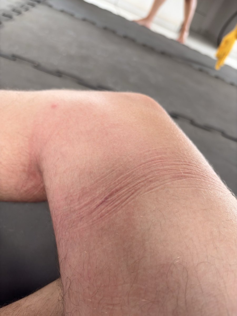 carlordyy's tweet photo. Me queimei no tecido de manha e minha perna n para de doer to começando a ficar preocupado https://t.co/pB4MFDIOK4