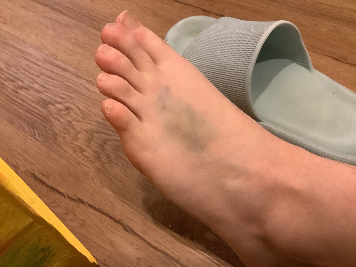 I dropped a soup bottle on my foot it’s still bruised…..💀