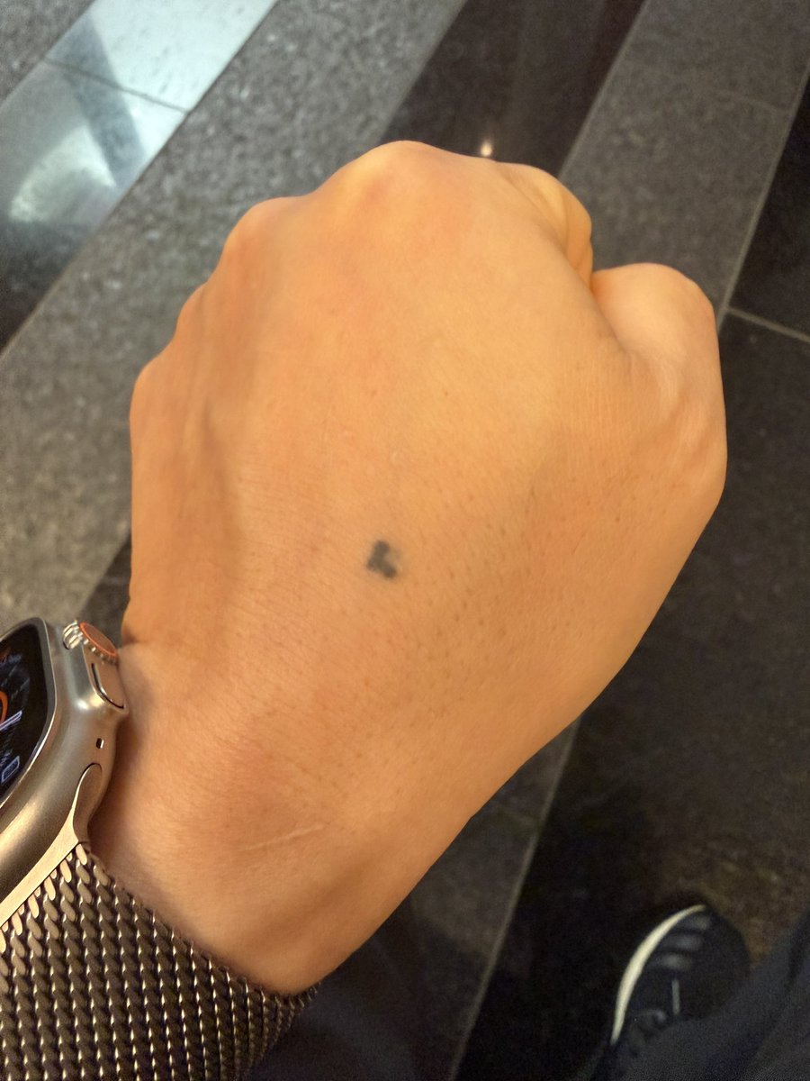 저도 혹시 모르니까 검사해보는게 좋겠다고 해서
예전에 일부분을 떼서 조직검사를 한 적이 있는데,
그것 때문에 점이 마치 하트모양처럼 되어서, 
문신했냐고 묻는 분들이 가끔 있습니다. ㅎㅎ