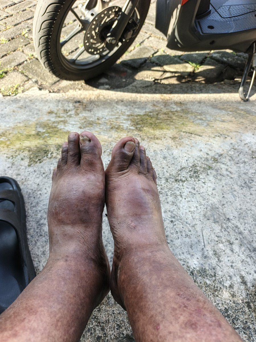 Tonyjonatan1971's tweet image. Pengen Resign dari Dunia perOjolan GO-JEK karena kaki semakin bengkak,, 
Tapi cicilan tagihan gk bisa libur,.. 😫😭