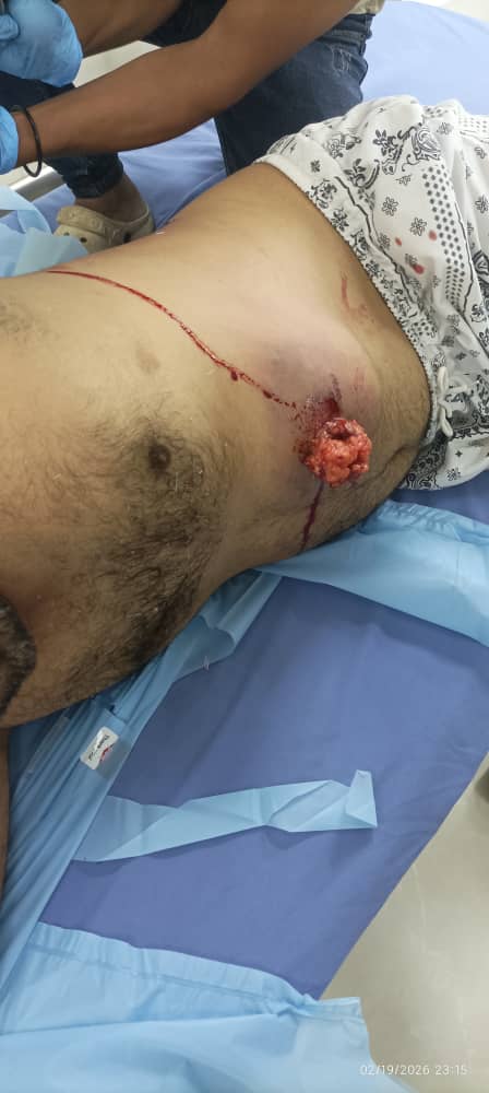 عاجل.

مصدر ... تزايد أعداد الجرحى حيث سقط العشرات من المتظاهرين السلميين عند بوابة المعاشيق في العاصمة عدن، إثر إطلاق نار مباشر بالرصاص الحي استهدف المحتجين السلميين،و تركزت معظم الإصابات في مناطق حساسة في اجسادهم.

هذا التصعيد الخطير يمثل انتهاكًا صارخًا للقانون الدولي.