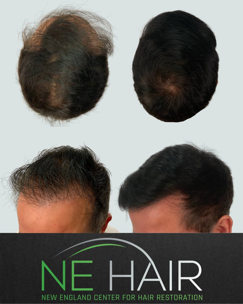 nehair's tweet image. 1 year follow up ⚡️ 2K Grafts⁠
⁠
microFUE Hair Transplant⁠ ⚡️⁠
⁠
⁠
We use hybrid proprietary micro punches, stem cell serum, and diamond sapphire blade incision sites for the BEST results. ⁠
⁠
⁠
⁠
⁠
#microfue #fuehairtransplant #hairtransformation#hairtransplantUSA