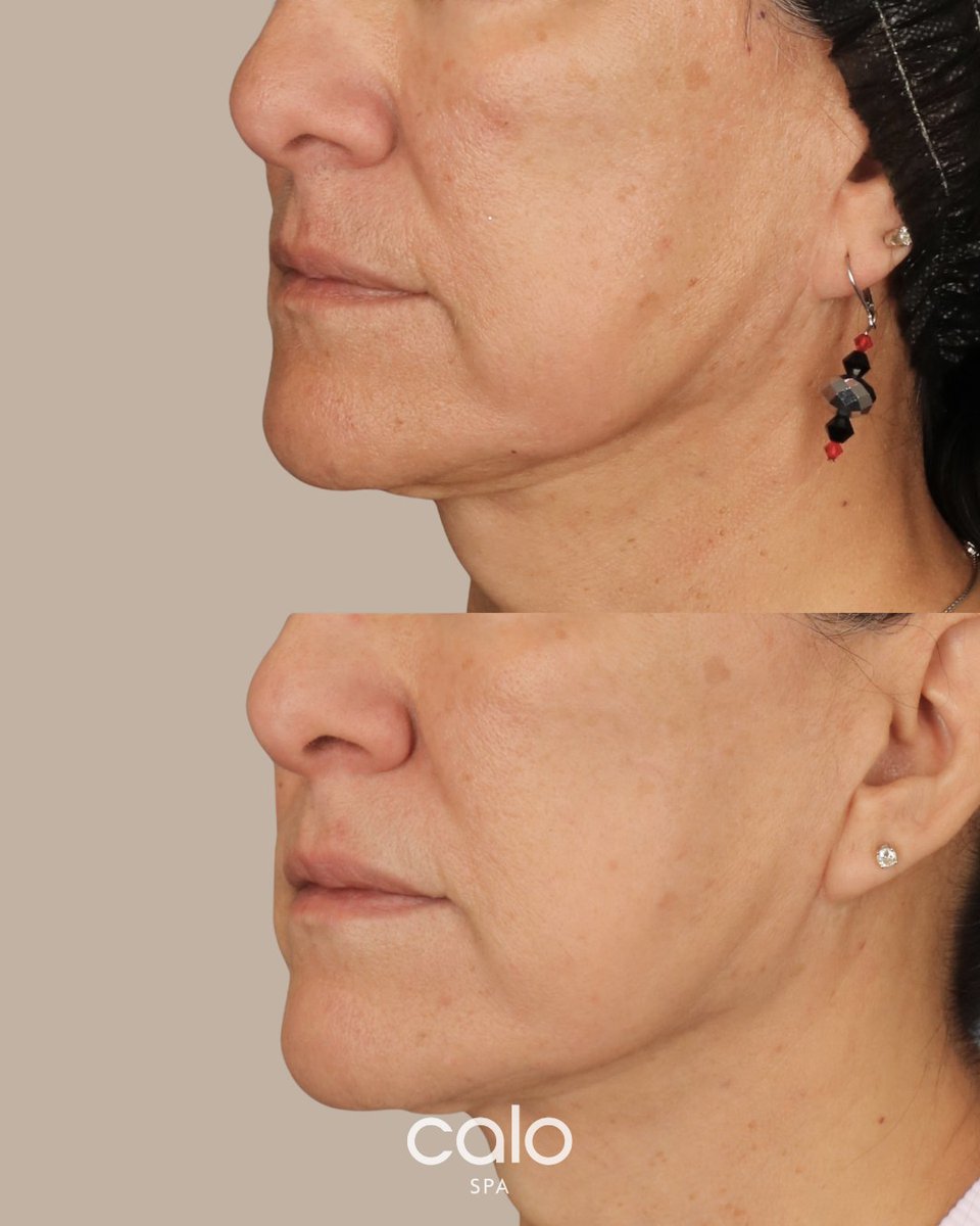 calospa's tweet photo. This patient saw Sayre and was wanting to get her skin ready for her vow renewal ceremony! After assessing her skin, Sayre did 2 BBL Heroic’s (4 weeks apart) and for her 3rd treatment, Sayre stacked BBL Heroic and Moxi to give her a little extra polishing. https://t.co/B8IC8uA2BJ