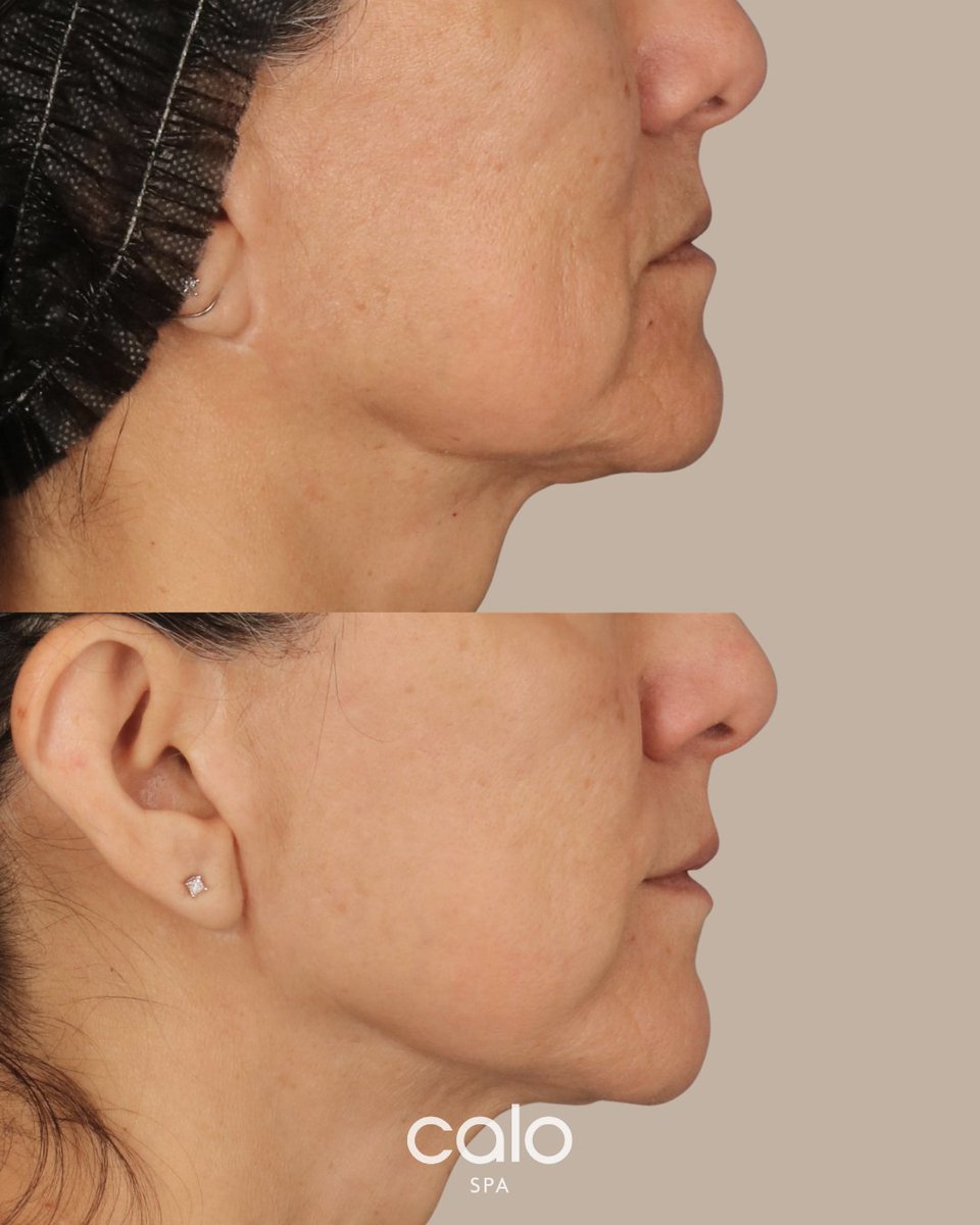 calospa's tweet photo. This patient saw Sayre and was wanting to get her skin ready for her vow renewal ceremony! After assessing her skin, Sayre did 2 BBL Heroic’s (4 weeks apart) and for her 3rd treatment, Sayre stacked BBL Heroic and Moxi to give her a little extra polishing. https://t.co/B8IC8uA2BJ