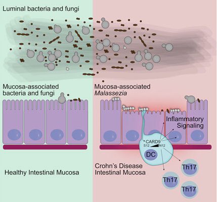 hepatologo_RCO's tweet photo. Malassezia sp es un hongo que ha mostrado una importante relación con #EnfermedadInflamatoriaIntestinal #EII; no solo provoca una mayor respuesta inflamatoria intestinal, sino que además puede estimular el desarrollo de la enfermedad y regular la respuesta al tratamiento. #CUCI #Crohn