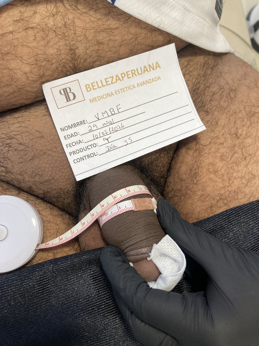 Dra__Fit's tweet photo. Hola mis Pepitos! 
Hoy les traigo este caso, llegó con una medida de 9.3 y después de 1 mes y 5 días la medida aumentó 2.7cm a 12cm de circunferencia.

Si tú también quieres tener estos resultados, escríbeme para agendar tu cita🍆🔥 https://t.co/oixXPDzd36