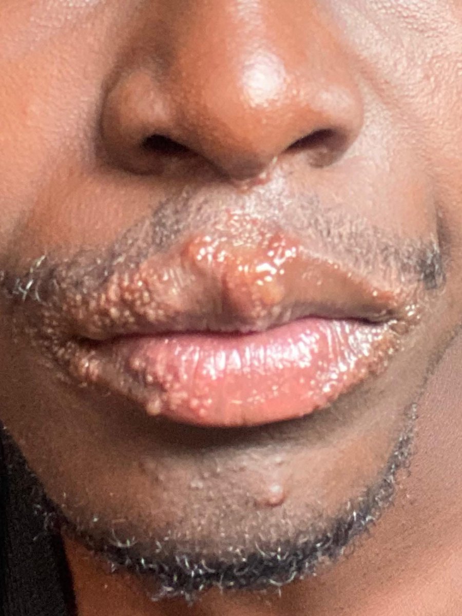 Really what causes this??

I've seen children who are not sexually active having this. 

I've heard this being called fever for years but what really is it?