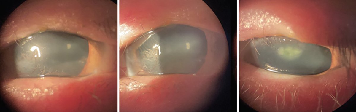 revoptom's tweet image. Keratitis Differential Diagnosis Through the Lens of Health Literacy

Lack of adequate attention to personal care and routine medical visits can predispose some individuals to corneal ulcers, as in this case. Read here: reviewofcontactlenses.com/article/kerati…

#keratitis #cornea #optometry