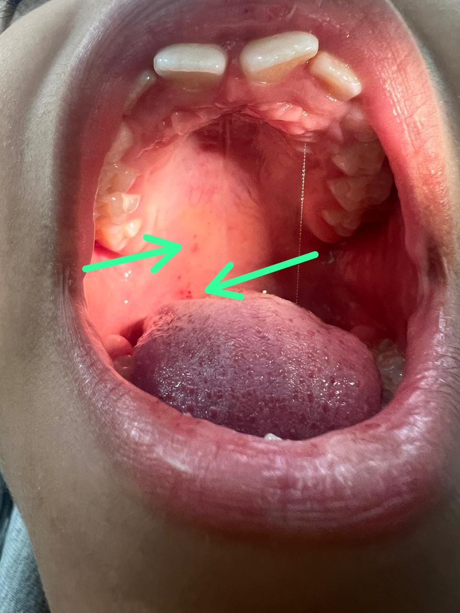6 years old. sore throat. fever and unpleasant breath smell with such reddish spots . what is the diagnosis?
<a href="/IhabFathiSulima/">Dr Ihab Suliman</a> #MEDHTM <a href="/hemo_shk/">Dr.Haitham Hamoud | د.هيثم</a> @Jkbjb1 #TooCloseToDiagnose <a href="/MoarSahitoPTI/">Dr. Muhammad Moor</a>
<a href="/MRCEMPREP/">Daily Dose of Medicine</a>
<a href="/neoskinhealer/">Dr. ISHWAR N RATHORE MD</a> <a href="/DrBassemKurdi/">د. باسم | طبيب أطفال</a>
@mohammadalmo