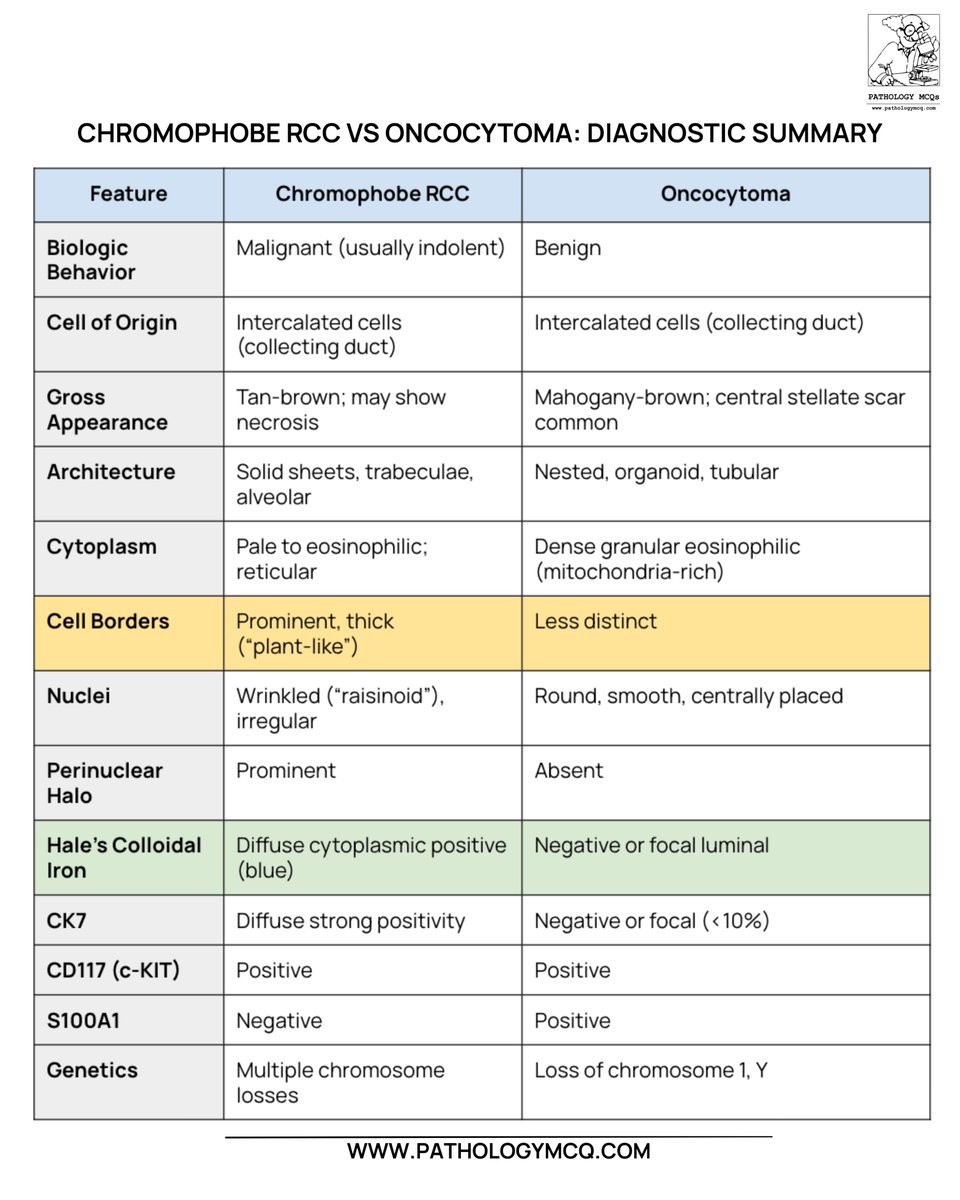 Pathology_mcqs's tweet photo. 🔬 Chromophobe RCC vs Oncocytoma

Raisinoid nuclei + perinuclear halo + diffuse CK7 → Chromophobe RCC
Round nuclei + granular cytoplasm + CK7 negative/focal → Oncocytoma
📌 Nuclear detail makes the diagnosis.

#RenalPathology #ChromophobeRCC #Oncocytoma #GUPathology #CK7 https://t.co/utQtK0wx5K
