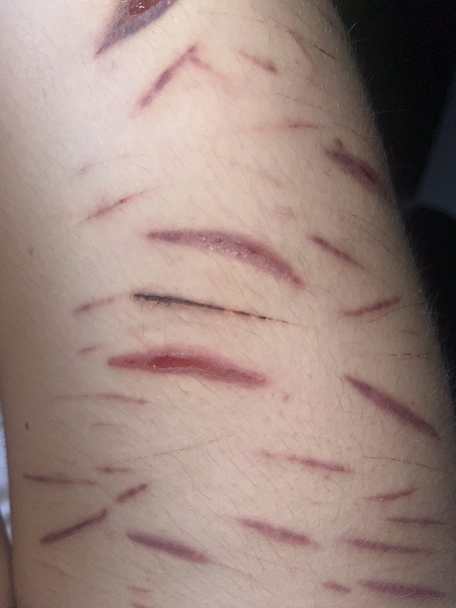 These fricking blood blisters on my scars yo