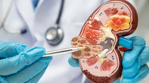 La función renal en nuestra salud es fundamental para evitar una diálisis o trasplante. Revisa esta nota con la Doctora, Carolina Cordero, Nefróloga jefa de la Unidad de Nefrología 👉hsjd.redsalud.gob.cl/wp-admin/post-…