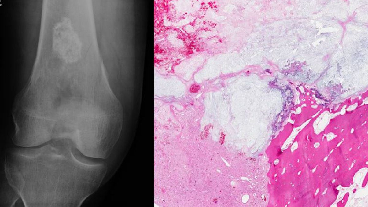 pathologistmag's tweet photo. What if pathology and radiology shared a single diagnostic report?

Dr. Dariusz Borys explains why closer integration between the two could improve cancer diagnosis and patient care.

👉 Read more: https://t.co/22r55TllfN
#Pathology #Radiology https://t.co/F9hYLtT1si