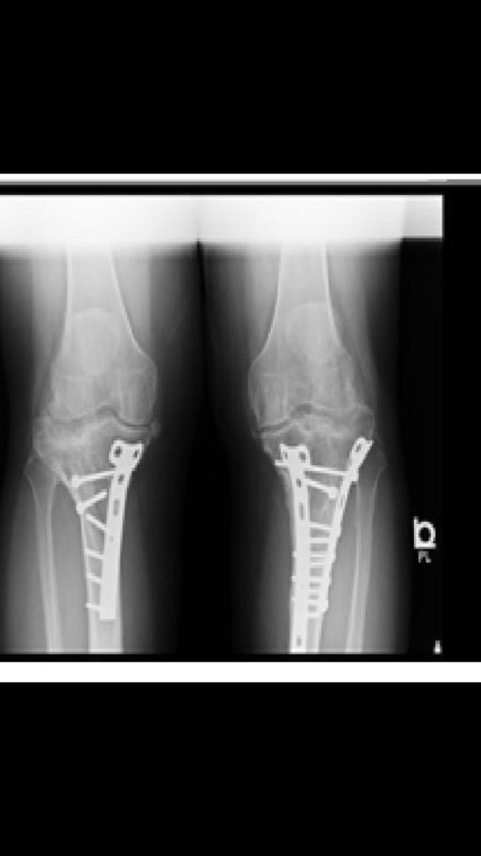 bpsample's tweet photo. @lindseyvonn Welcome to the club. Hoping your recovery goes well https://t.co/rrK9DAuViQ