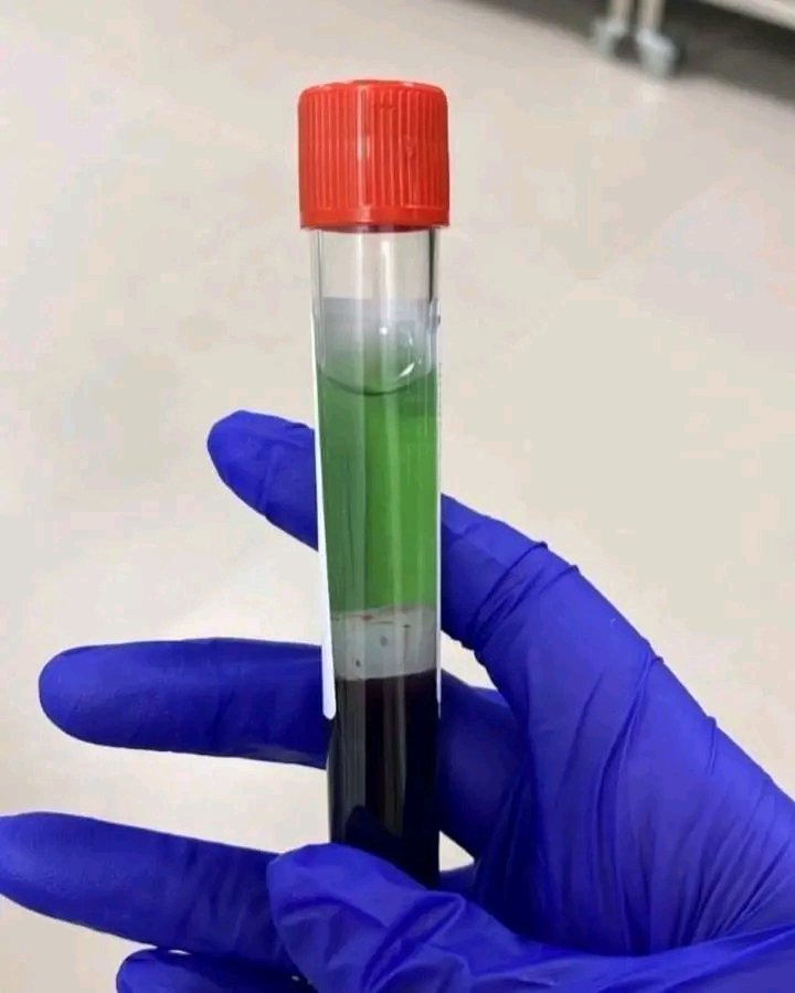 This blood sample was drawn from a patient. He is not ill, and the blood is not contaminated.

Why does it appear green in color? 🤔