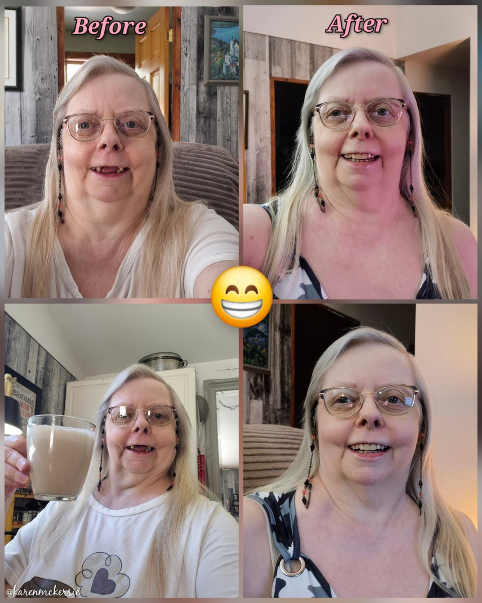 karenmckersie's tweet photo. 😁🦷 I Finally Got My New Teeth Guys!! Top and Bottom partials. What do you think!? Im so happy after over 4 months with no teeth, it will take me awhile to get used to them...😁🦷🦷👌 #Dentist #NewTeeth #BigSmile #Partials #Teeth #WhatDoYouThink #Happy #FridayVibes #BeforeAfter https://t.co/CAHZwjOfpB