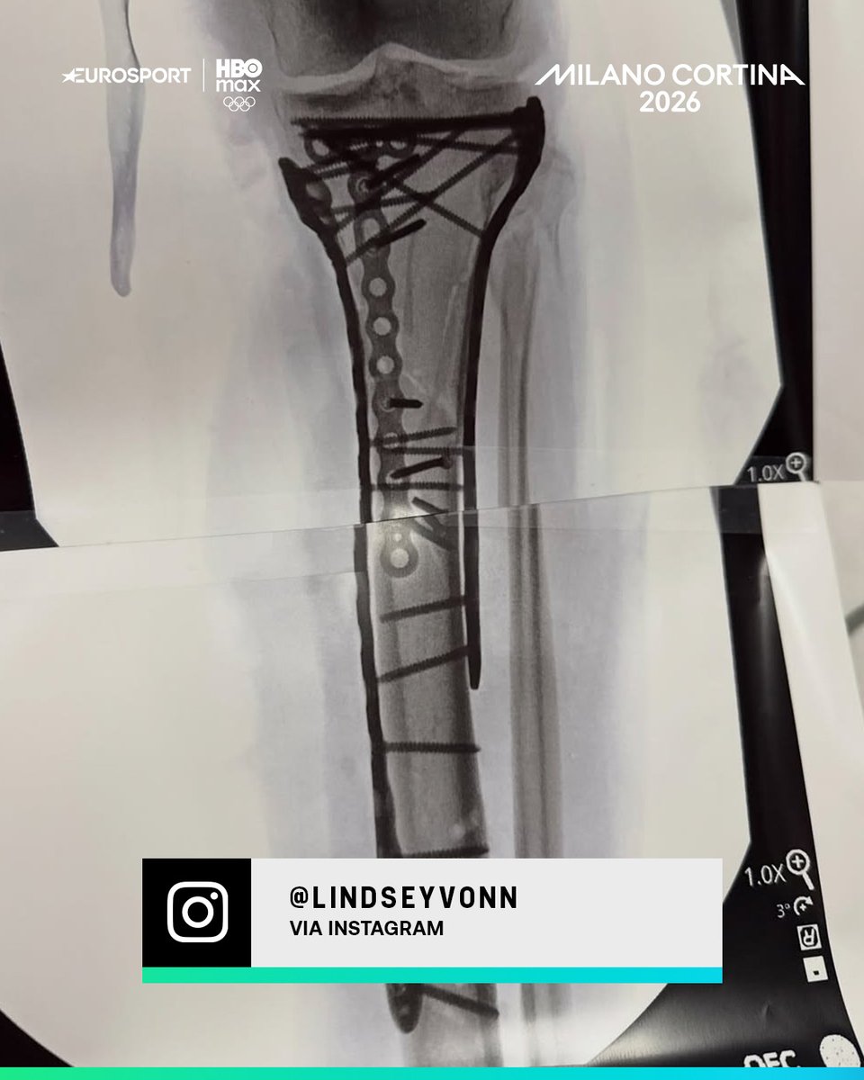 Las impactantes radiografías de <a href="/lindseyvonn/">lindsey vonn</a>. #MilanoCortina2026