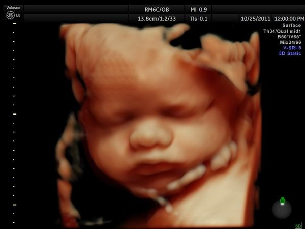 HUGE!

Unborn babies experience consciousness.

A new study was published in a peer-reviewed medical journal. A neonatologist reviewed 31 clinical trials from the last decade and confirms babies before birth are conscious.

lifenews.com/2026/02/20/stu…