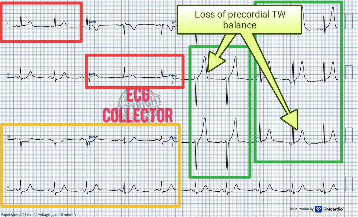 OMI signs detected‼️‼️🚑🚑

#ECG shows:
1. Tall broad symmetrical TW in V2-V5 ,⏩ Hyperacute TW
2. Subtle STE Lead 1, aVL and V2 with STD Lead 3 ⏭️🇿🇦🇿🇦
3. Reciprocal STD inferior leads
4. Loss of Precordial TW balance⏭️ TW V2 larger than V6

🔺LAD OMI

- DCB to mid LAD/D1