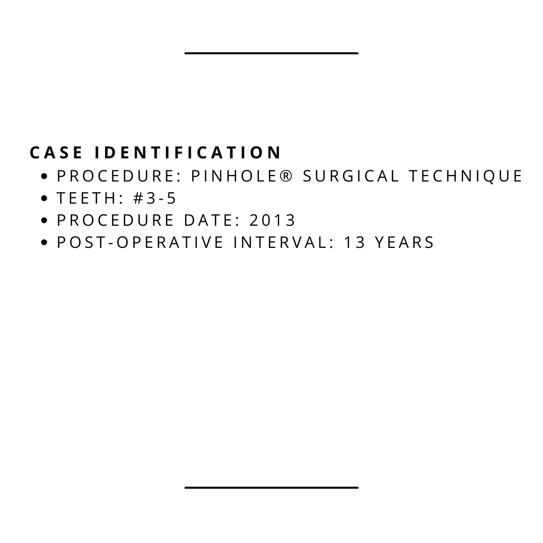 JohnChaodds's tweet photo. Clinical Observation — Gingival Recession
Pinhole® Surgical Technique | Teeth #3–5 | Procedure year: 2013 | Follow-up: ≈13 years (2026 observation)
At long-term intervals, interpretation centers on tissue health and stability of the soft-tissue environment. https://t.co/YpP1YmafCd