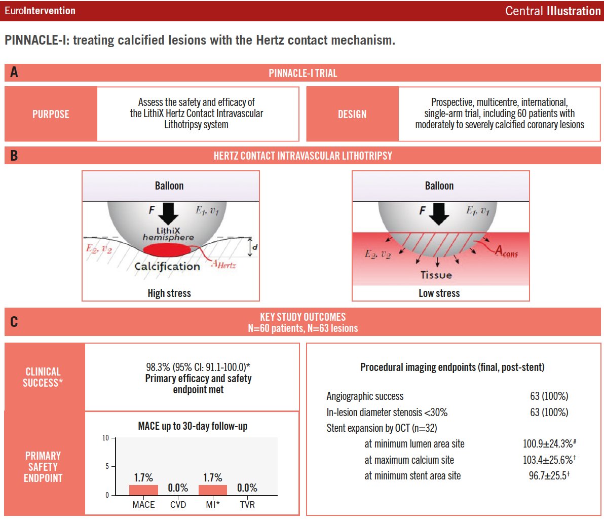 EuroInterventio's tweet photo. The novel LithiX Hertz Contact IVL catheter fractures coronary calcium via a unique Hertz contact mechanism—no external energy source required. Early outcomes show high procedural success, >90% calcium fractures, and optimal stent expansion across diverse morphologies. 
https://t.co/TmAFP3H1Vv

@valeriaparadies @ZMehmedbegovic @mc_morice