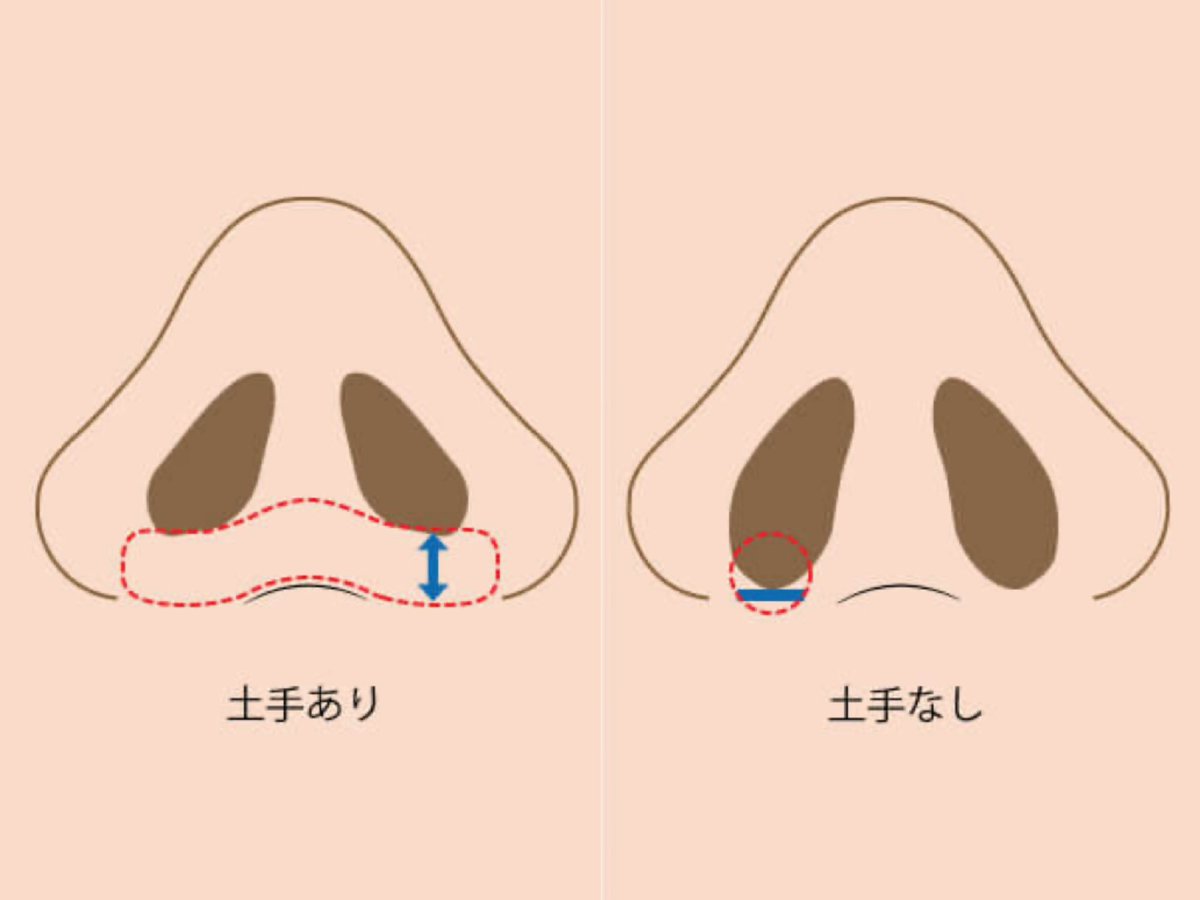 magjpwg's tweet photo. 土手を小鼻縮小とか人中短縮で切り取られて悲しんでる人をたくさん見てきた😭
土手あるかないかで見た目めちゃくちゃ変わるよね
1度なくなったら再建めちゃくちゃ大変みたいだし私は小鼻縮小すすめられたクリニックでは絶対にここなくなるか確認してた✅ https://t.co/7AutQO9rYN