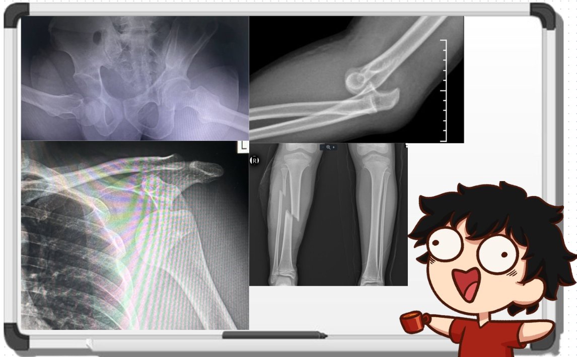 Unfortuantely, I was not able to prepare slides, so I'll be doing a Freestyle Whiteboard Lecture on the Common Orthopedic Emergencies in the ER this 2/21/26 10PM GMT +8!

Expect me to go into every Orthopedic tangent in the course of the lecture.

See you!

#ENVTuber #Ortho