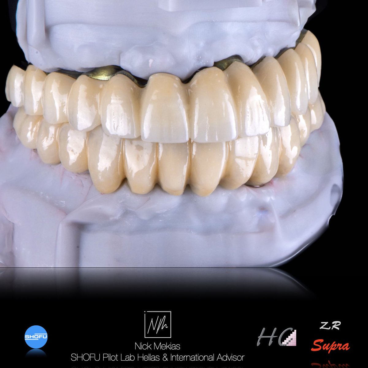 NikosMekias's tweet image. Precision meets aesthetics. 🦷✨ High-end restoration for both arches.
Upper: In-house milled Ti-bar (anodized), SHOFU ZR Supra cut-back, 6 anterior build-up (Vintage ZR).
Lower: Metal bar, SHOFU HC Hybrid Composite micro-layering (6 anterior) with Ceramage. 
#Shofu #NikosMekias